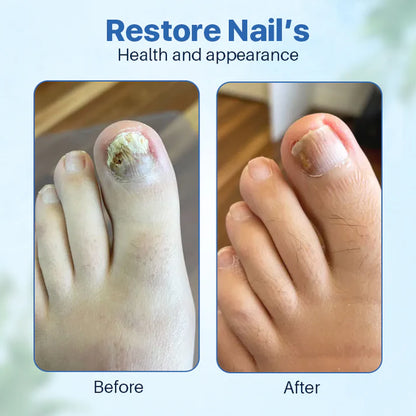 Anti-Fungal Nail Repair Ointment